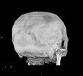 Cerebral hemorrhagic contusions (Radiopaedia 23145-23188 3D MIP 9).jpg