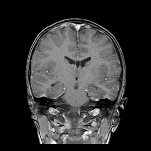 File:Cerebral tuberculoma (Radiopaedia 41152-43932 Coronal T1 C+ 10).jpg