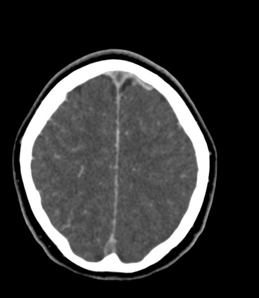 File:Cerebral venous sinus thrombosis (Radiopaedia 59224-66646 Axial C+ delayed 12).jpg