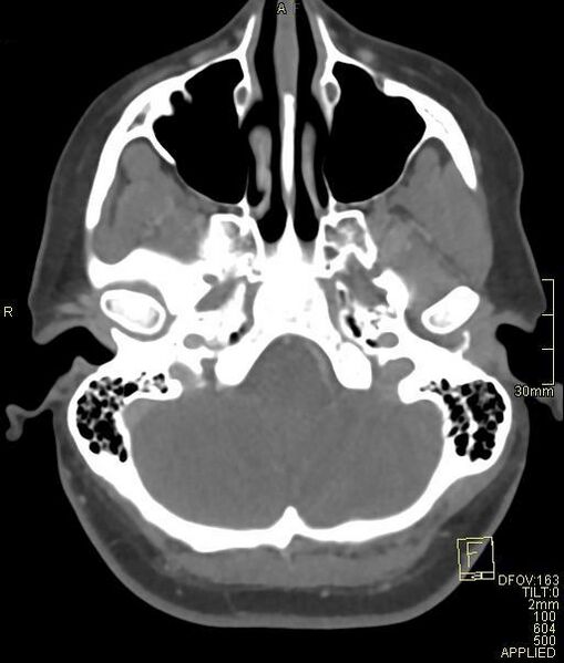 File:Cerebral venous sinus thrombosis (Radiopaedia 91329-108965 Axial venogram 17).jpg