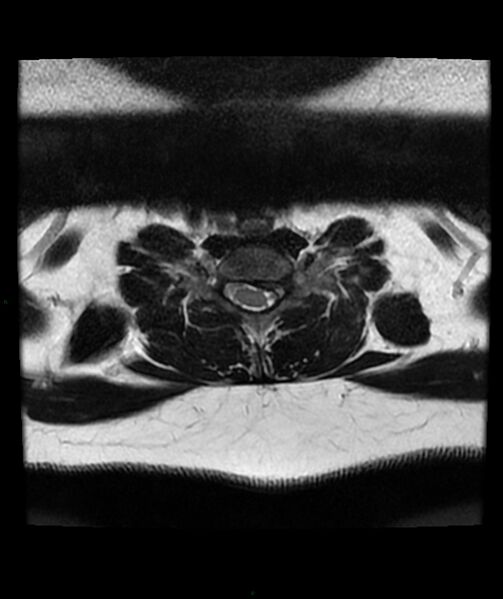 File:Cervical disc prolapse (Radiopaedia 80258-93598 Axial T2 61).jpg