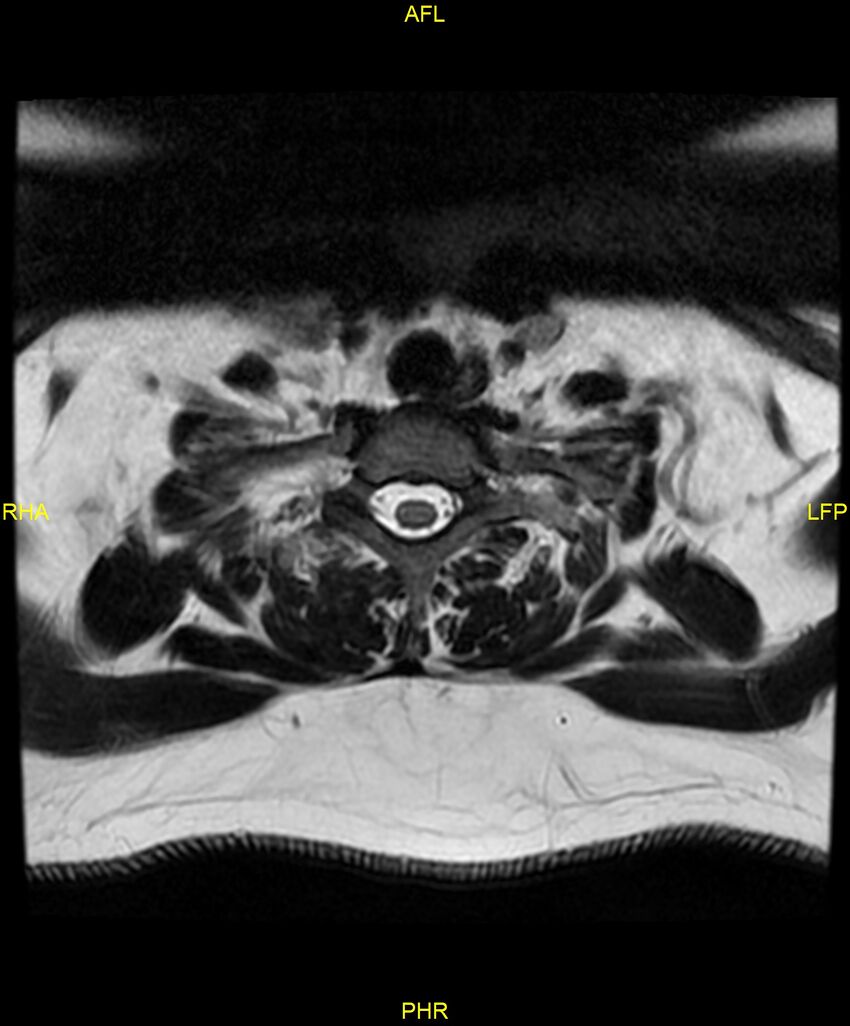 Cervical disc protrusion (Radiopaedia 87147-103415 Axial T2 74).jpg