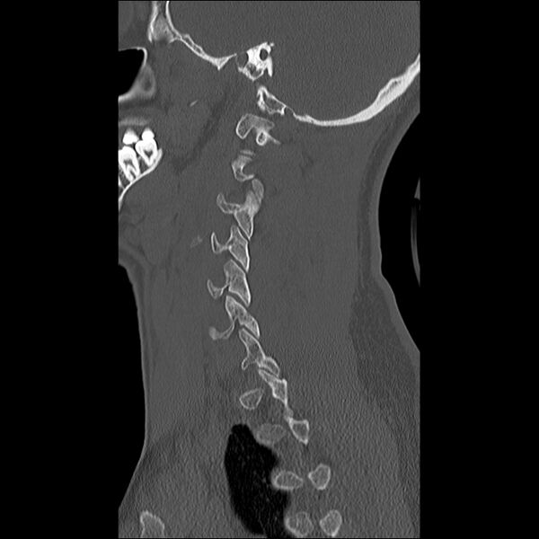 File:Cervical facet fracture and anterior discoligamentous injury (Radiopaedia 32139-33083 Sagittal bone window 7).jpg
