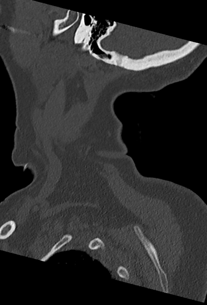 File:Cervical spine ACDF loosening (Radiopaedia 48998-54070 Sagittal bone window 11).png
