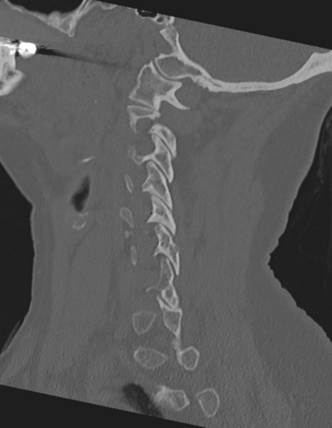 File:Cervical spine ACDF loosening (Radiopaedia 48998-54071 Sagittal bone window 30).png