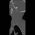 Cervical spine fractures with vertebral artery dissection (Radiopaedia 32135-33078 Sagittal bone window 3).jpg