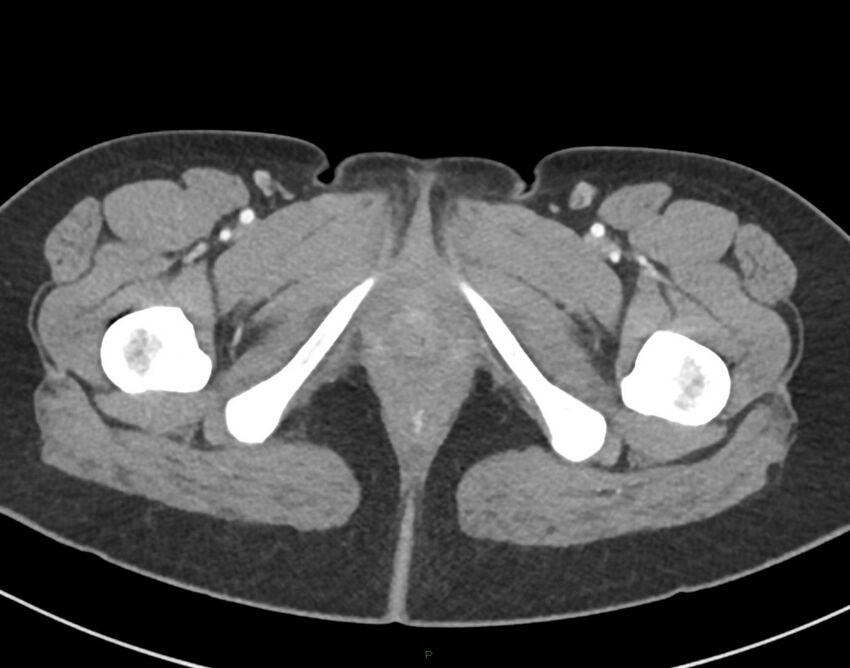 Cesarean scar endometriosis (Radiopaedia 82925-97262 A 93).jpg
