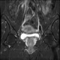 Cesarian section scar endometriosis (Radiopaedia 66520-75799 Coronal STIR 16).jpg