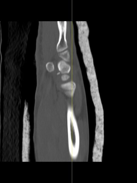 File:Chauffeur's (Hutchinson) fracture (Radiopaedia 58043-65079 Sagittal bone window 2).jpg