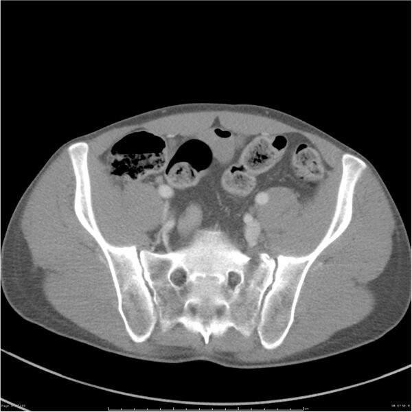 File:Chest and abdomen multi-trauma (Radiopaedia 26294-26426 A 67).jpg