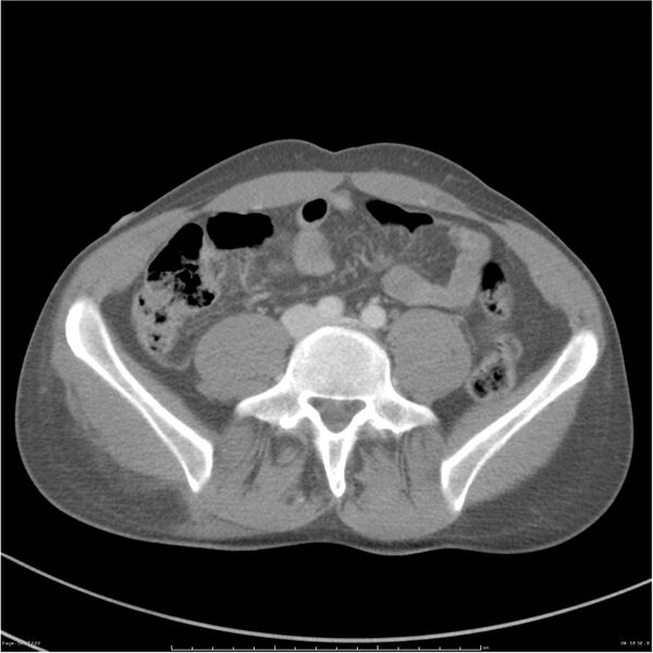 File:Chest and abdomen multi-trauma (Radiopaedia 26294-26426 bone window 58).jpg