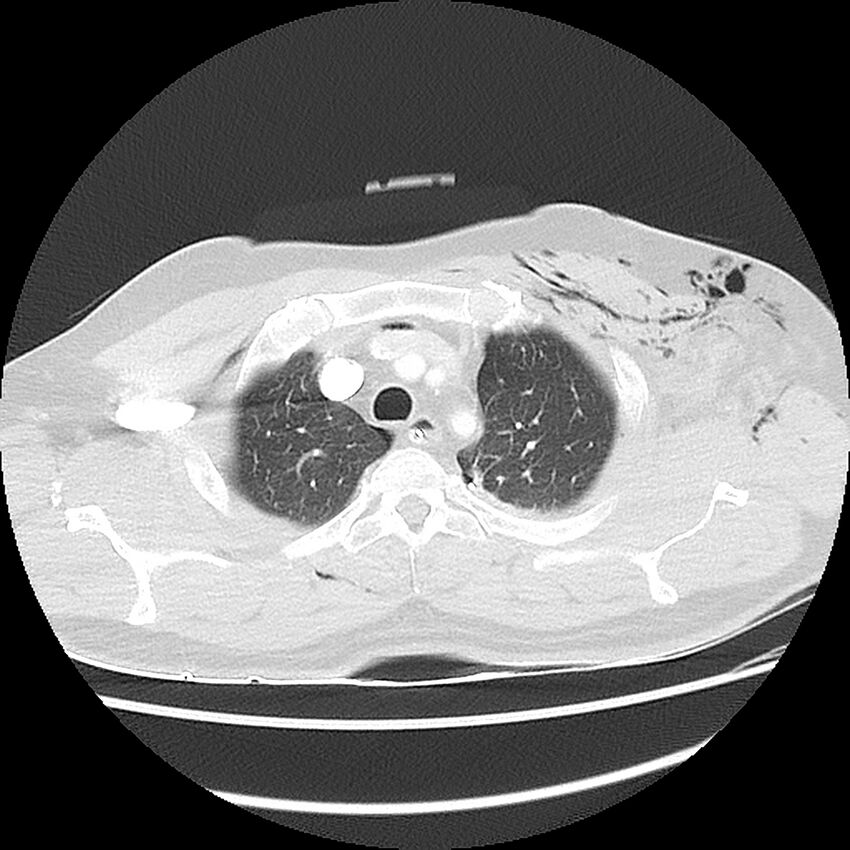 Chest crush injury (Radiopaedia 31620-32513 Axial lung window 14).jpg