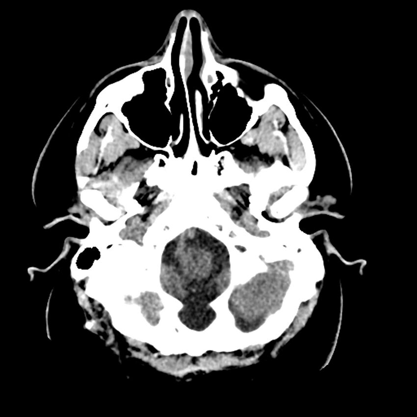 Chiasmatic-hypothalamic juvenile pilocytic astrocytoma (Radiopaedia 78533-91237 Axial non-contrast 11).jpg