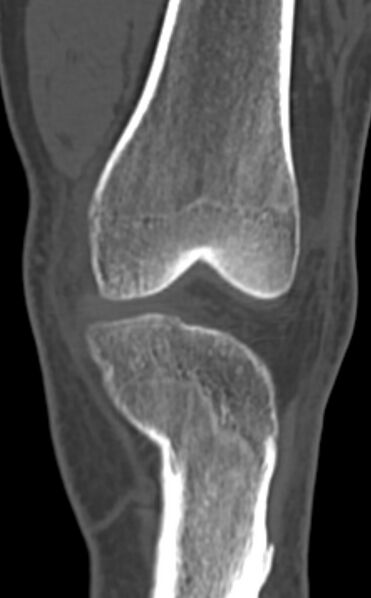 File:Chondrocalcinosis (Radiopaedia 82862-97173 Coronal bone window 27).jpg