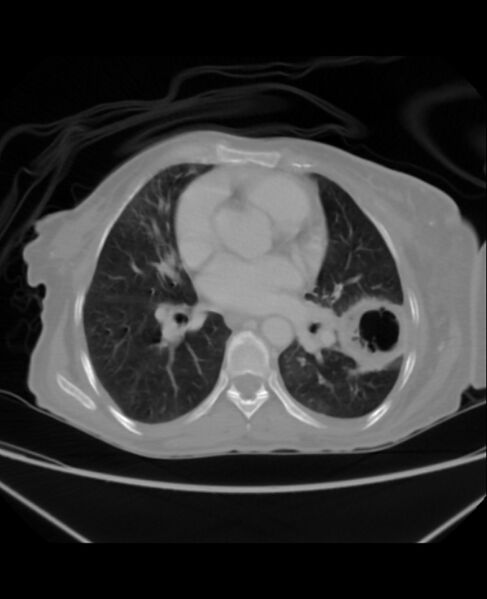 File:Chondrosarcoma (Radiopaedia 79427-92535 Axial lung window 29).jpg
