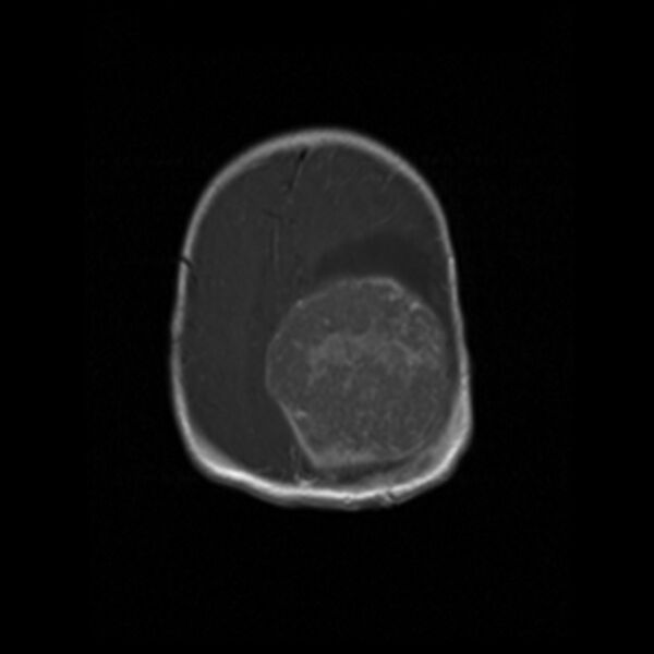 File:Choroid plexus carcinoma (Radiopaedia 21121-21035 Axial T1 C+ 16).jpg