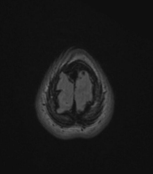 File:Choroid plexus carcinoma (Radiopaedia 91013-108553 Axial FLAIR C+ 197).jpg