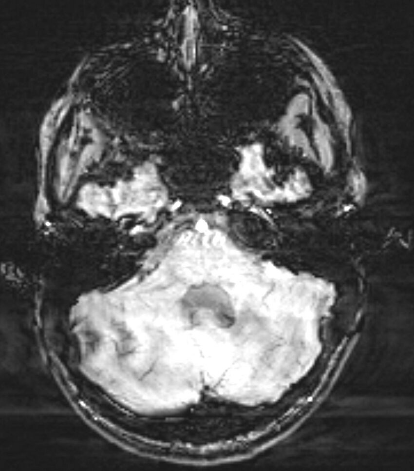 Choroid plexus carcinoma (Radiopaedia 91013-108553 Axial SWI 23).jpg