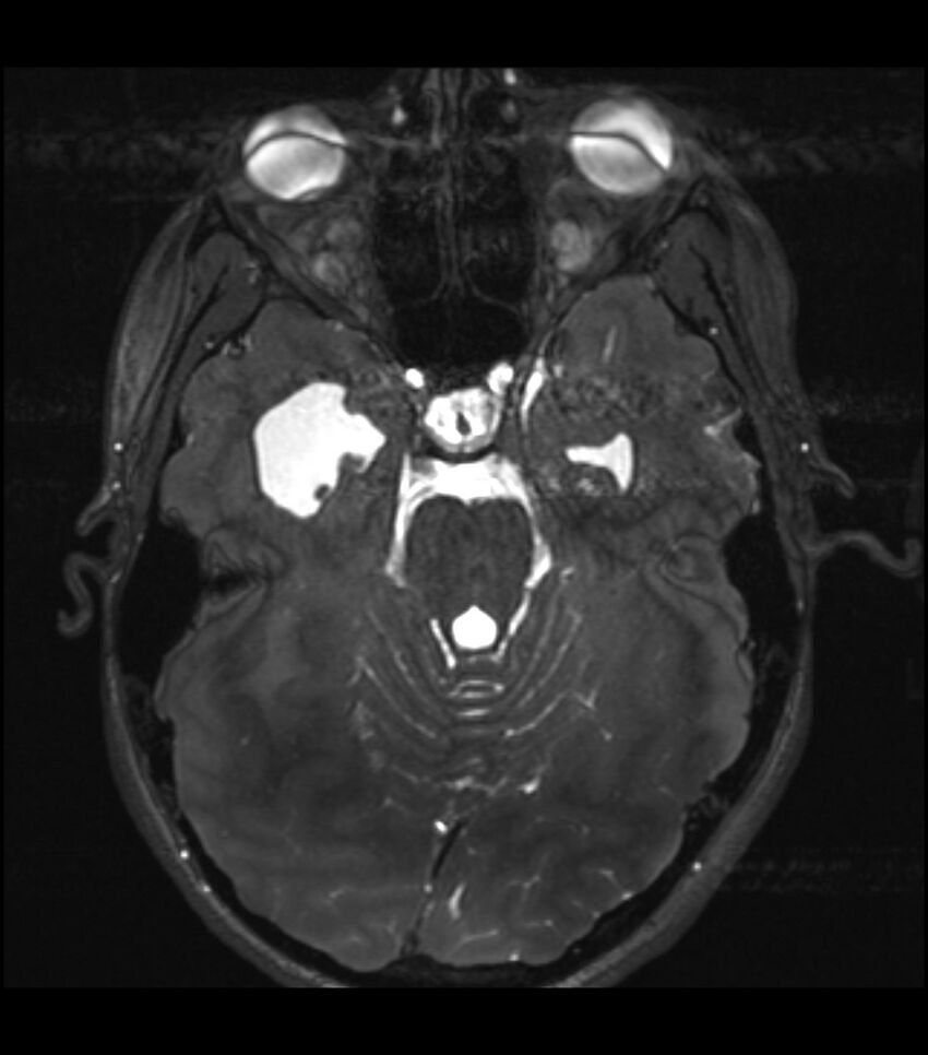 Choroid plexus carcinoma (Radiopaedia 91013-108553 Axial T2 CISS 7).jpg