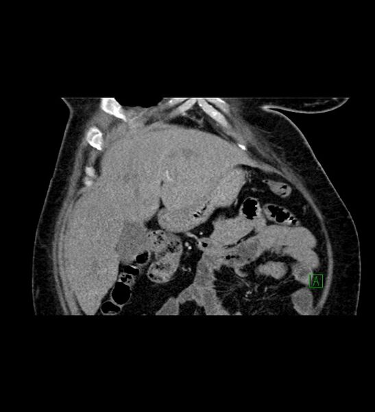 File:Chromophobe renal cell carcinoma (Radiopaedia 84239-99519 C 24).jpg