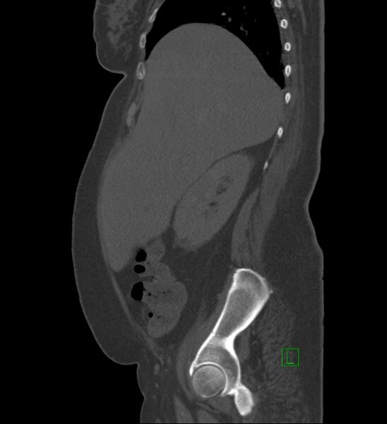 File:Chromophobe renal cell carcinoma (Radiopaedia 84239-99519 Sagittal bone window 80).jpg