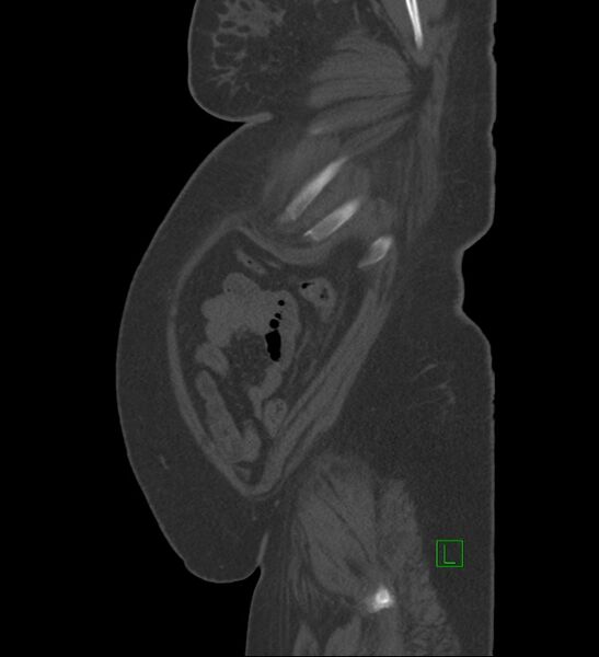 File:Chromophobe renal cell carcinoma (Radiopaedia 84239-99519 Sagittal bone window 9).jpg