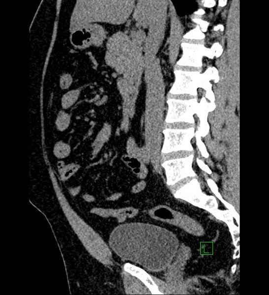 File:Chromophobe renal cell carcinoma (Radiopaedia 84286-99573 C 99).jpg