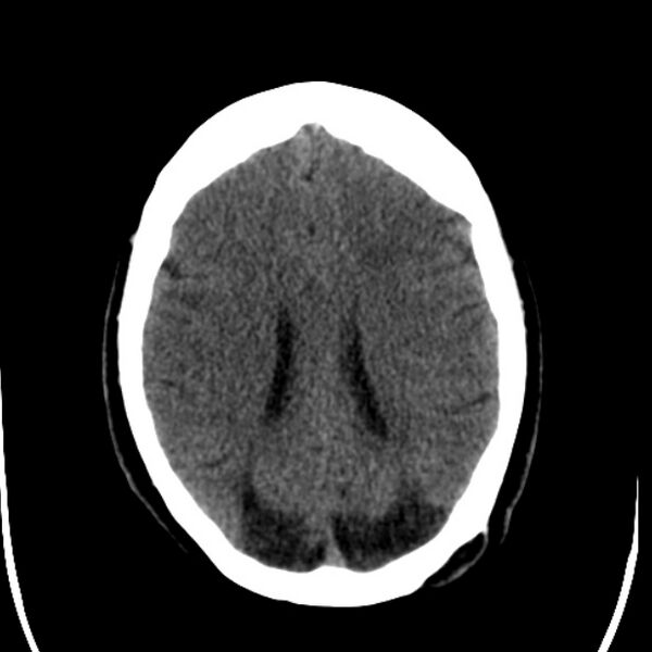 File:Chronic bilateral occipital lobe infarcts (Radiopaedia 31276-31996 Axial non-contrast 28).jpg