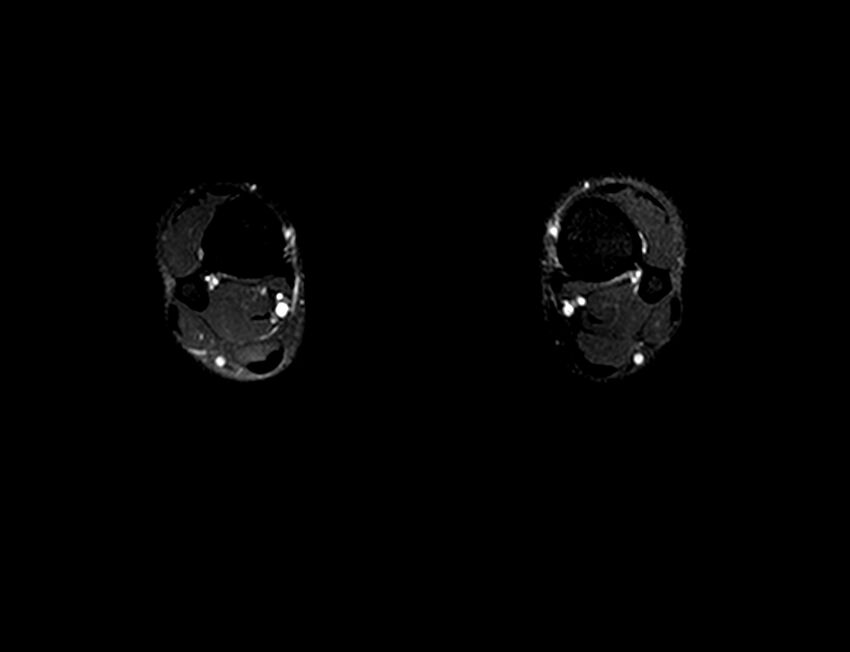 Chronic exertional compartment syndrome (Radiopaedia 43615-47036 Axial STIR 8).jpg