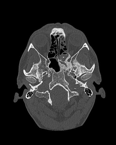 File:Chronic maxillary sinusitis caused by a foreign body (Radiopaedia 58521-65676 Axial bone window 200).jpg