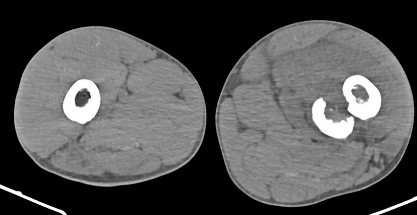 Chronic osteomyelitis (with sequestrum) (Radiopaedia 74813-85822 D 81).jpg