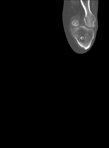 File:Chronic osteomyelitis - tibia (with sequestrum) (Radiopaedia 73273-84090 Coronal non-contrast 12).jpg