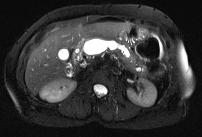 File:Chronic pancreatitis - pancreatic duct calculi (Radiopaedia 71818-82250 Axial T2 fat sat 28).jpg