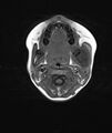 Chronic reactive multifocal osteomyelitis (CRMO) - mandible (Radiopaedia 56405-63069 Axial T1 13).jpg