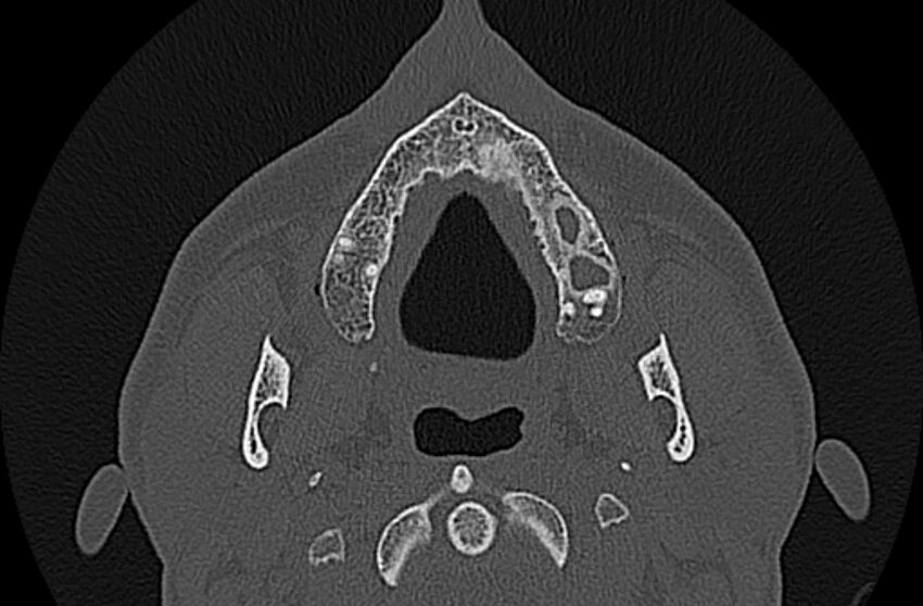 Chronic rhinosinusitis (Radiopaedia 65079-74075 Axial bone window 3).jpg
