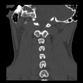 Clay-shoveler fracture (Radiopaedia 22568-22590 Coronal bone window 25).jpg