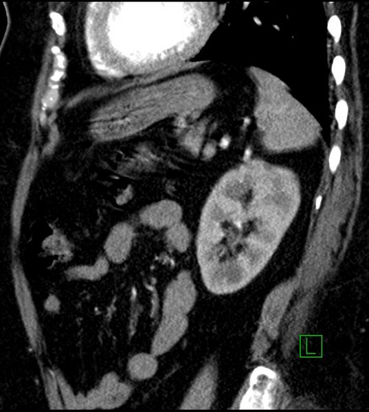 File:Clear cell renal cell carcinoma (Radiopaedia 85004-100537 D 19).jpg