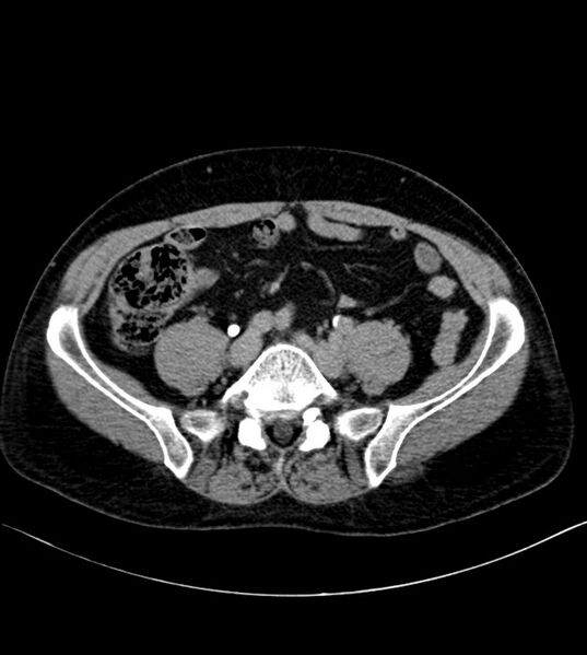 File:Clear cell renal cell carcinoma (Radiopaedia 85006-100539 H 41).jpg