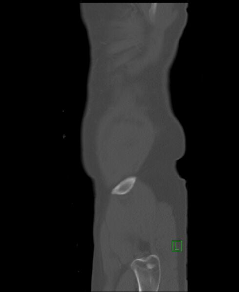 File:Clear cell renal cell carcinoma (Radiopaedia 85006-100539 Sagittal bone window 2).jpg