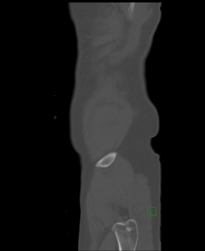 Clear cell renal cell carcinoma (Radiopaedia 85006-100539 Sagittal bone window 2).jpg