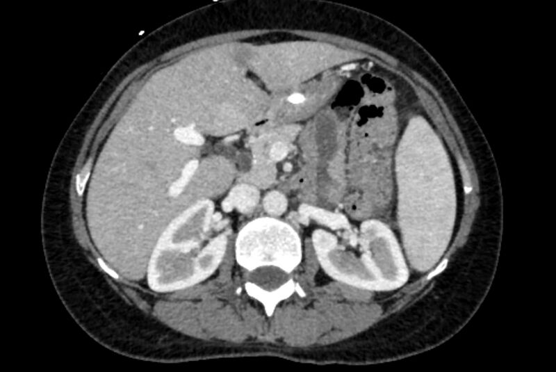 File:Closed loop small bowel obstruction (Radiopaedia 71211-81508 A 25).jpg