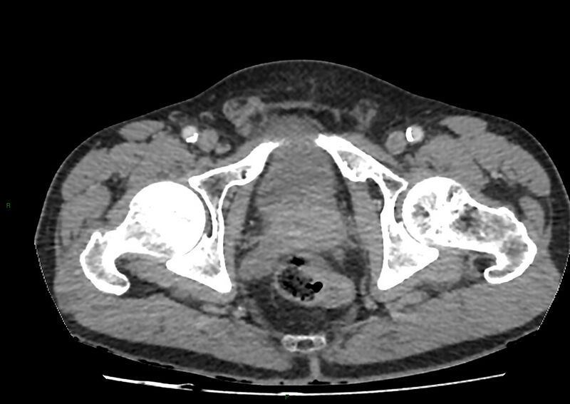 File:Closed loop small bowel obstruction with ischemia (Radiopaedia 84180-99456 A 117).jpg