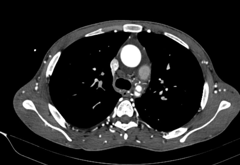File:Coarctation of aorta with aortic valve stenosis (Radiopaedia 70463-80574 A 56).jpg