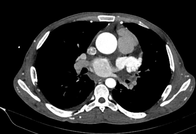 File:Coarctation of aorta with aortic valve stenosis (Radiopaedia 70463-80574 A 95).jpg