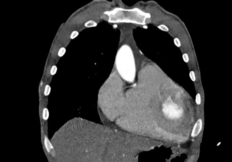 File:Coarctation of aorta with aortic valve stenosis (Radiopaedia 70463-80574 C 42).jpg