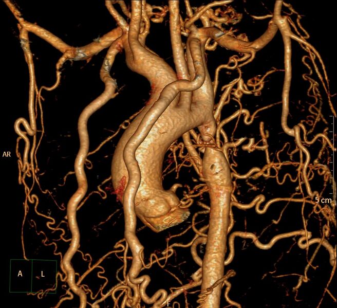 File:Coarctation of the aorta (Radiopaedia 27458-27657 3D 6).jpg