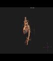 Coarctation of the aorta (Radiopaedia 43373-46729 3D reconstruction 16).jpg