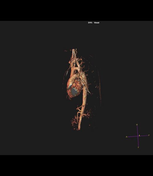 File:Coarctation of the aorta (Radiopaedia 43373-46729 3D reconstruction 16).jpg