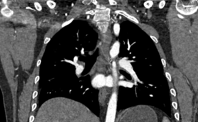 File:Coarctation of the aorta (Radiopaedia 53363-59343 C 41).jpg