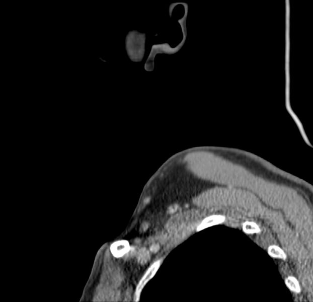 File:Colloid cyst of thyroid (Radiopaedia 22897-22923 Sagittal C+ delayed 4).jpg